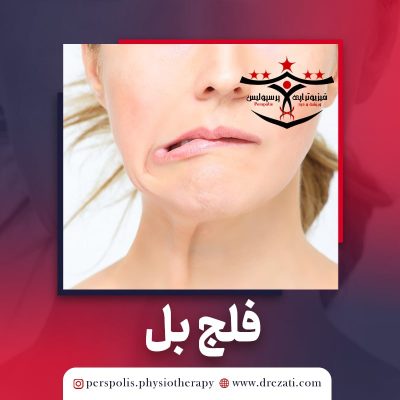 فیزیوتراپی تخصصی برای فلج عصب صورتی یا فلج بل