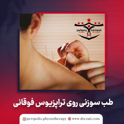 اثرات طب سوزنی خشک سطحی و عمقی برای بیماران ناشی از تراپزیوس فوقانی