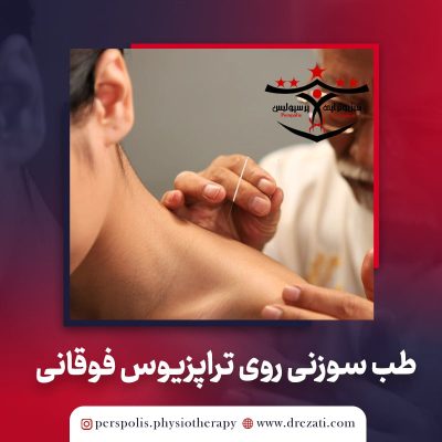 بررسی اثرات طب سوزنی خشک روی نقاط ماشه ای تراپزیوس فوقانی