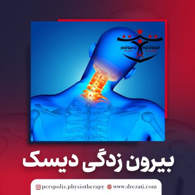 بیرون زدگی دیسک گردن