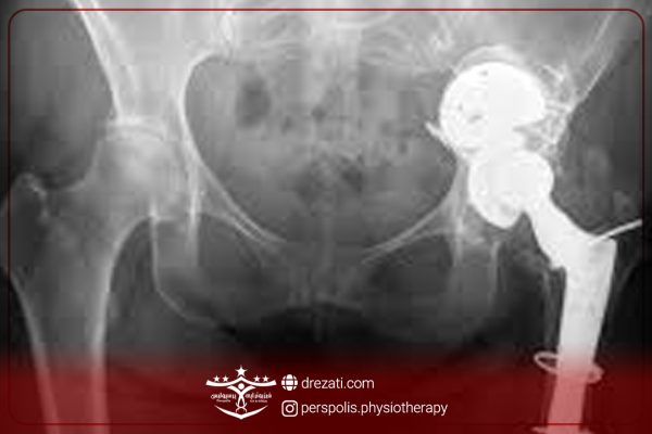 علل رایج درد مفصل ران چیست ؟