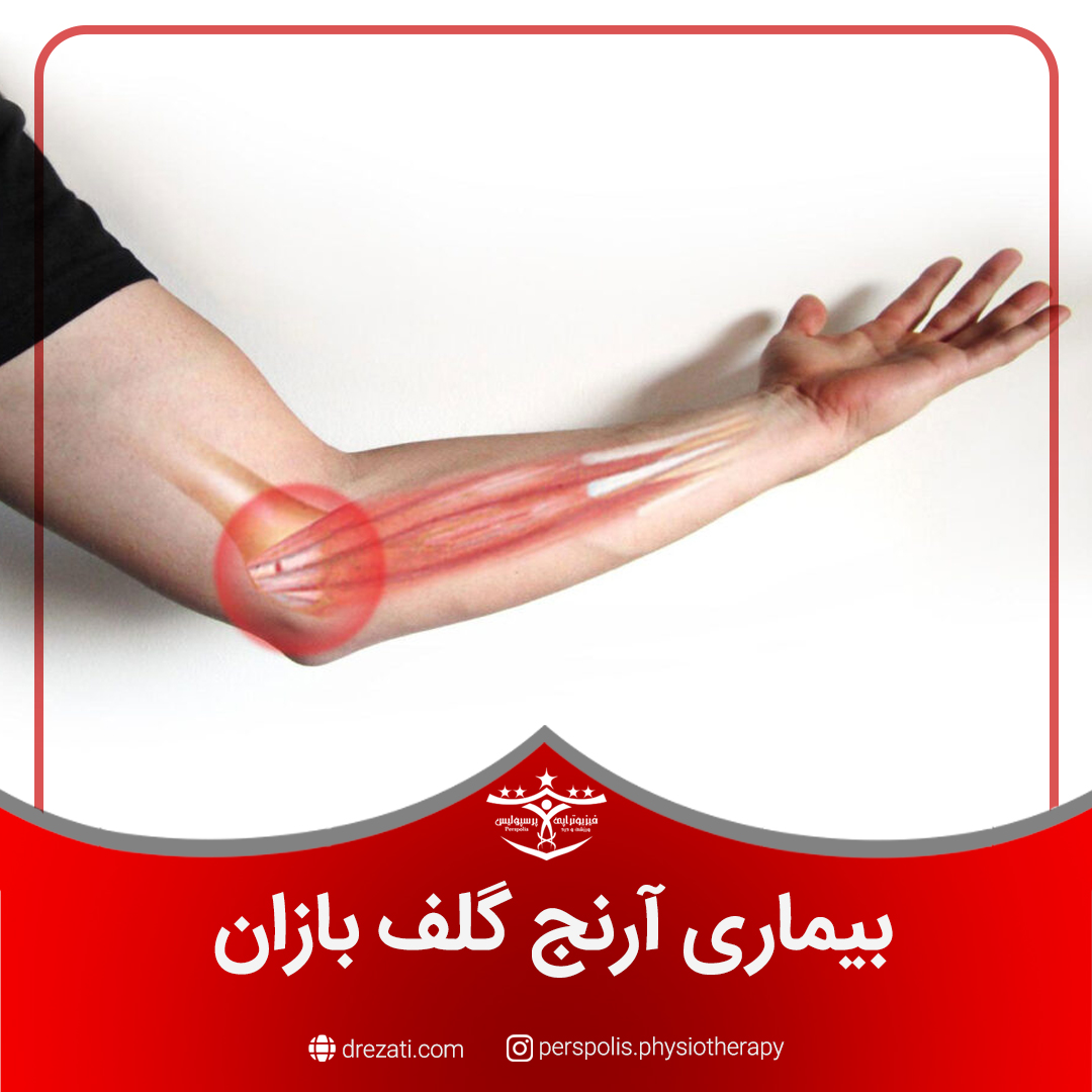 بیماری آرنج گلف بازان