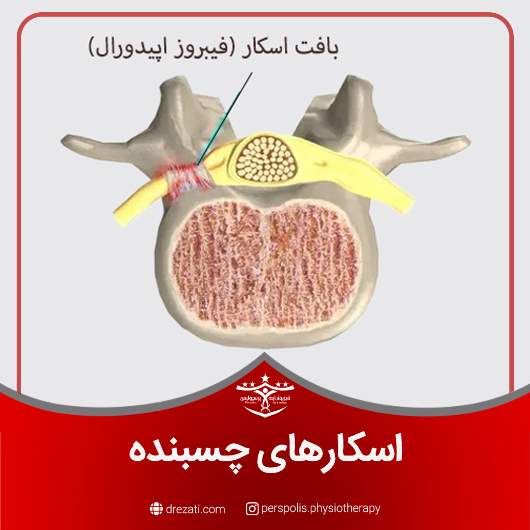 اسکارهای چسبنده چیست ؟