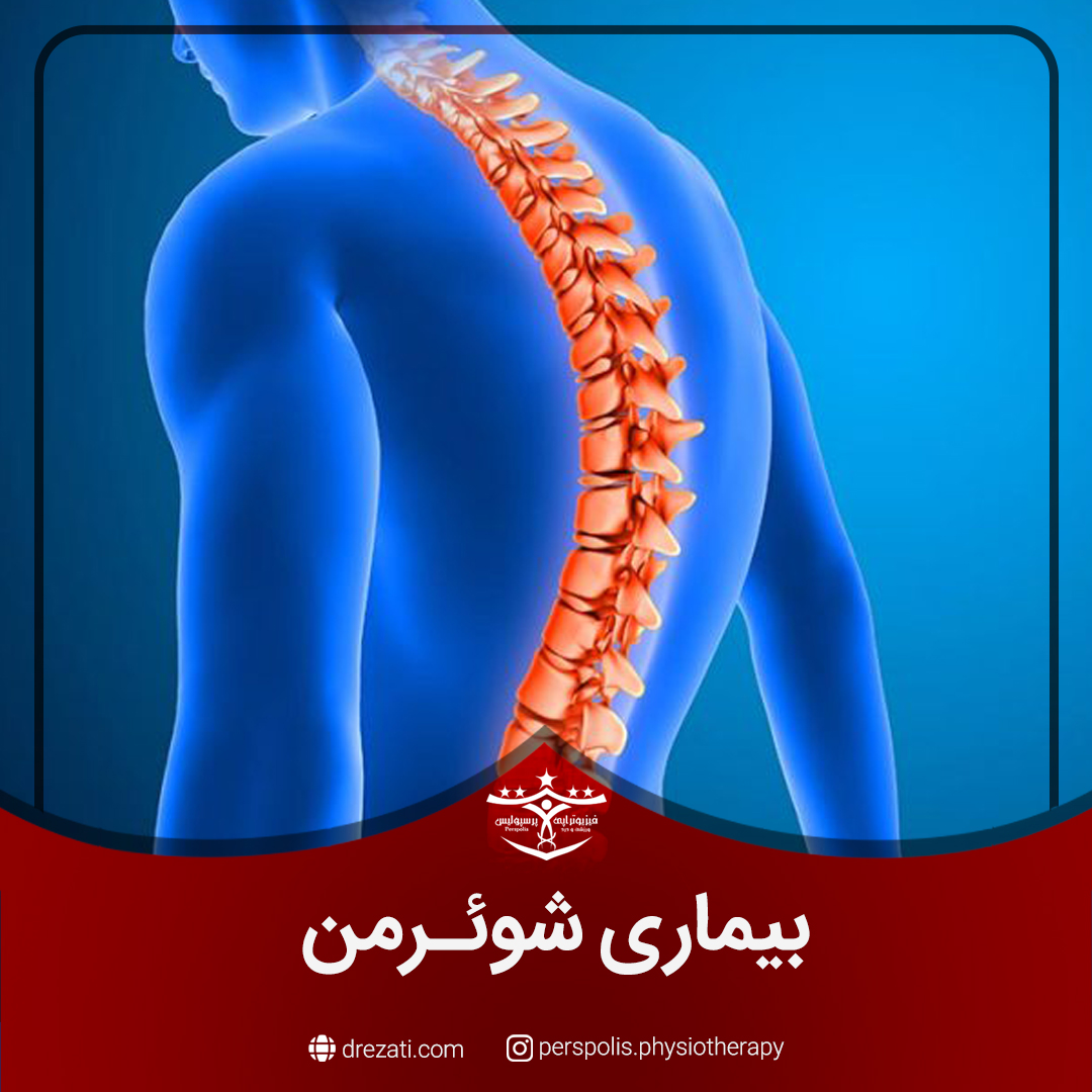 بیماری شوئرمن (Scheuermann’s Disease)