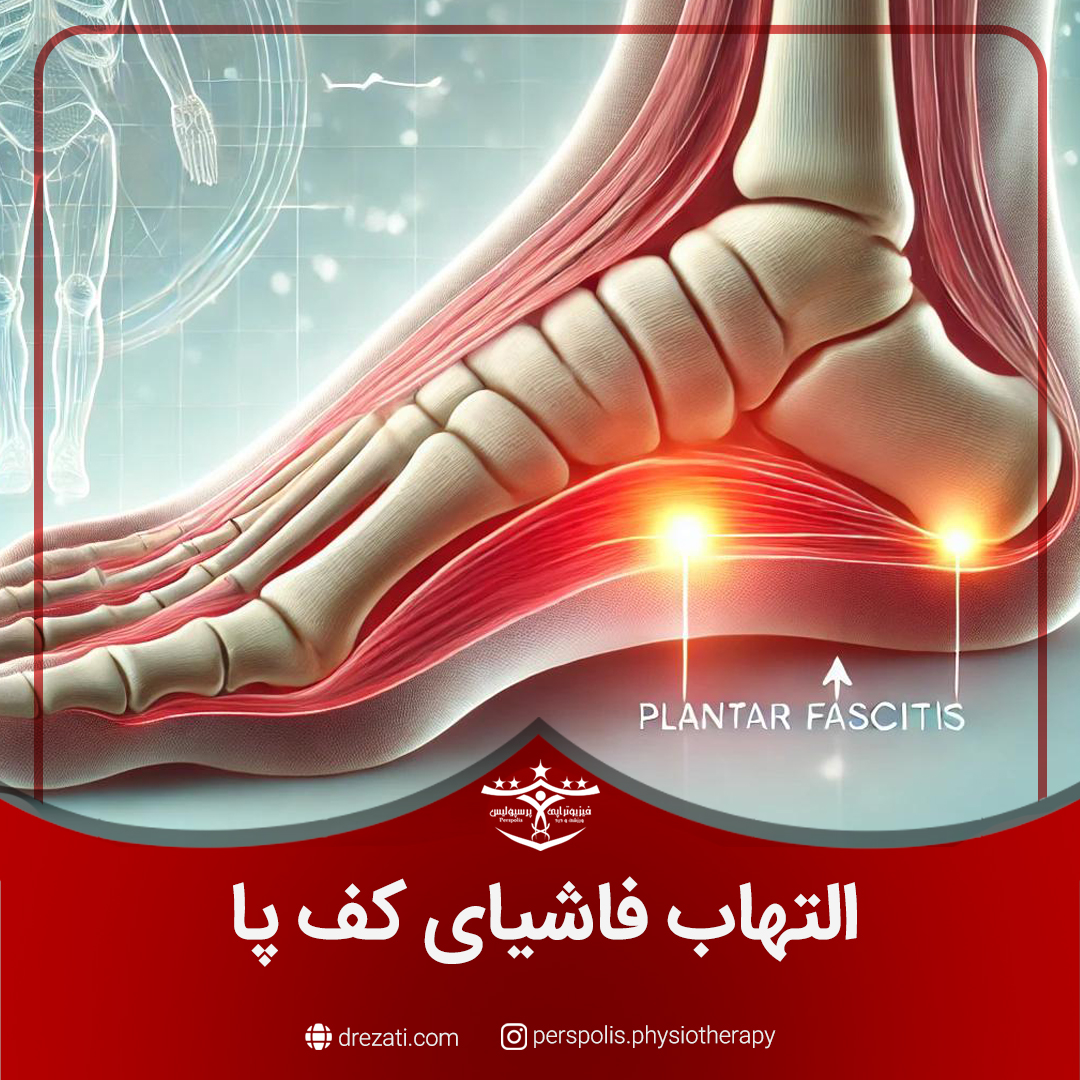التهاب فاشیای کف پا چیست؟