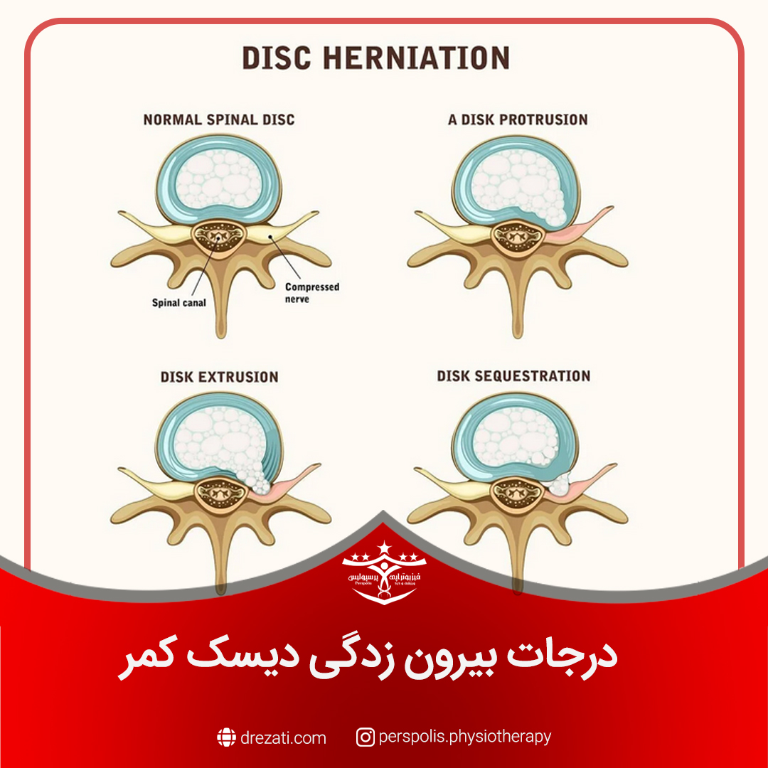 درجات بیرون زدگی دیسک کمر