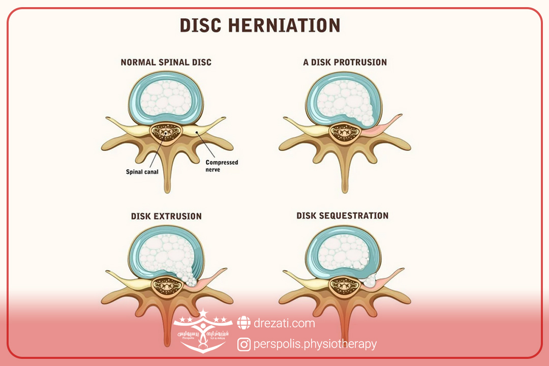 درجات بیرون زدگی دیسک کمر
