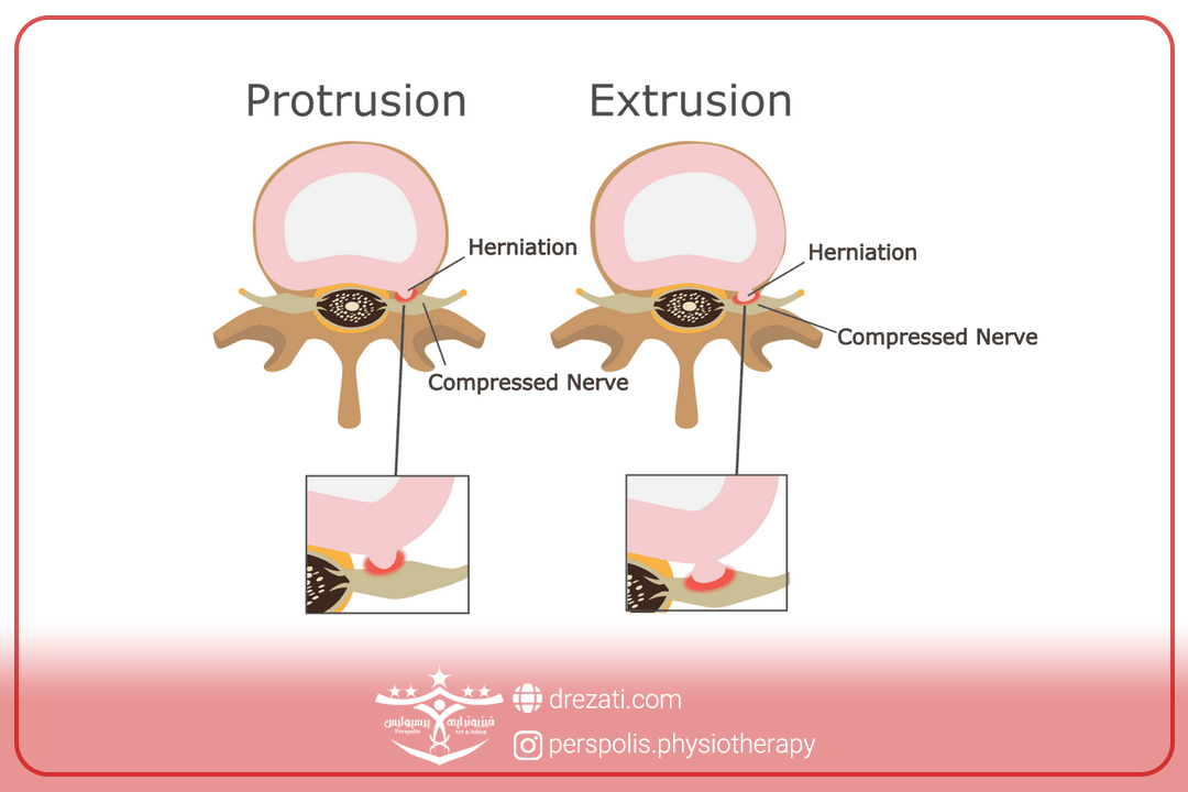 درجات بیرون زدگی دیسک کمر