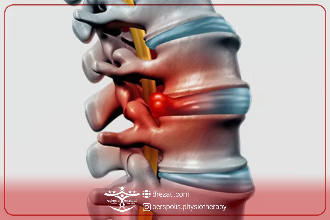 انواع بیرون زدگی دیسک کمر