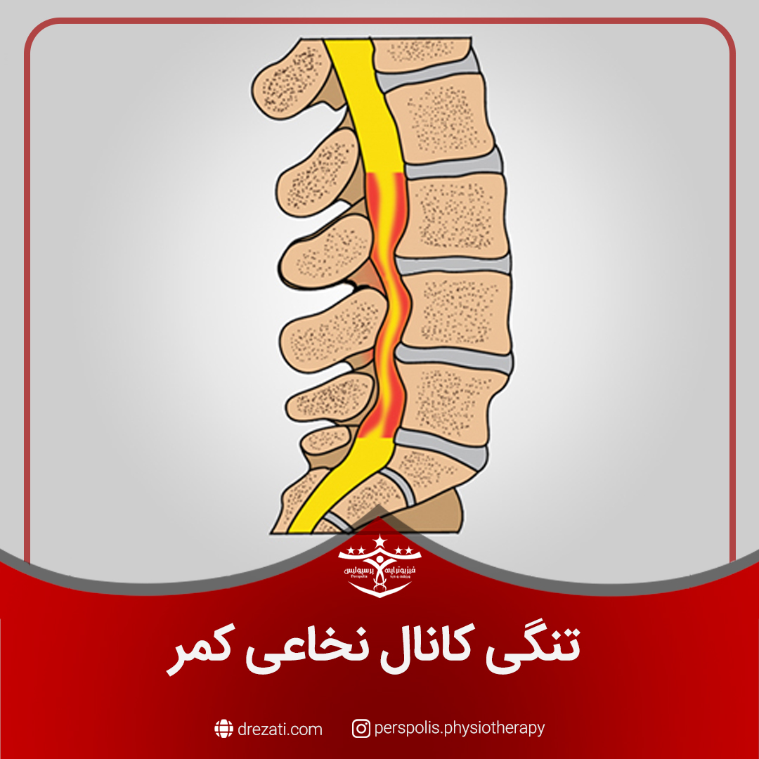 تنگی کانال نخاعی کمر