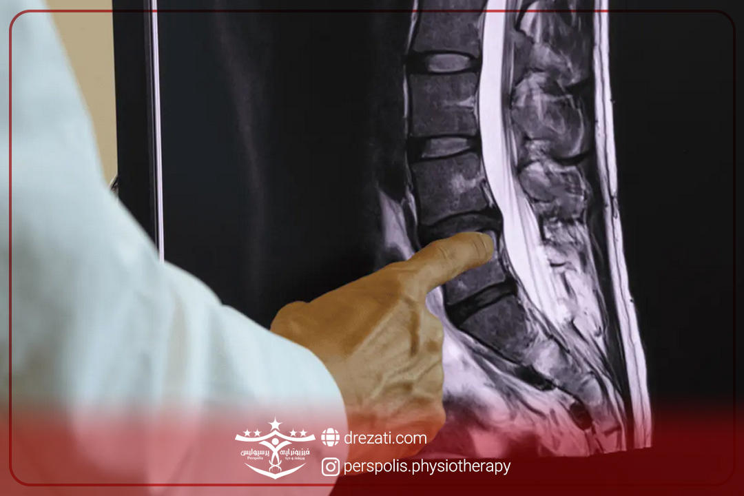 تنگی کانال نخاعی کمر