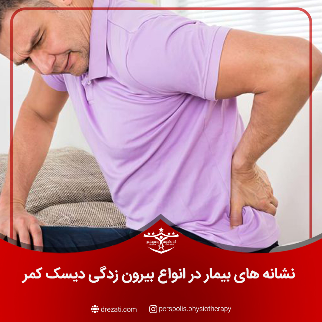 نشانه های بیمار در انواع بیرون زدگی دیسک کمر