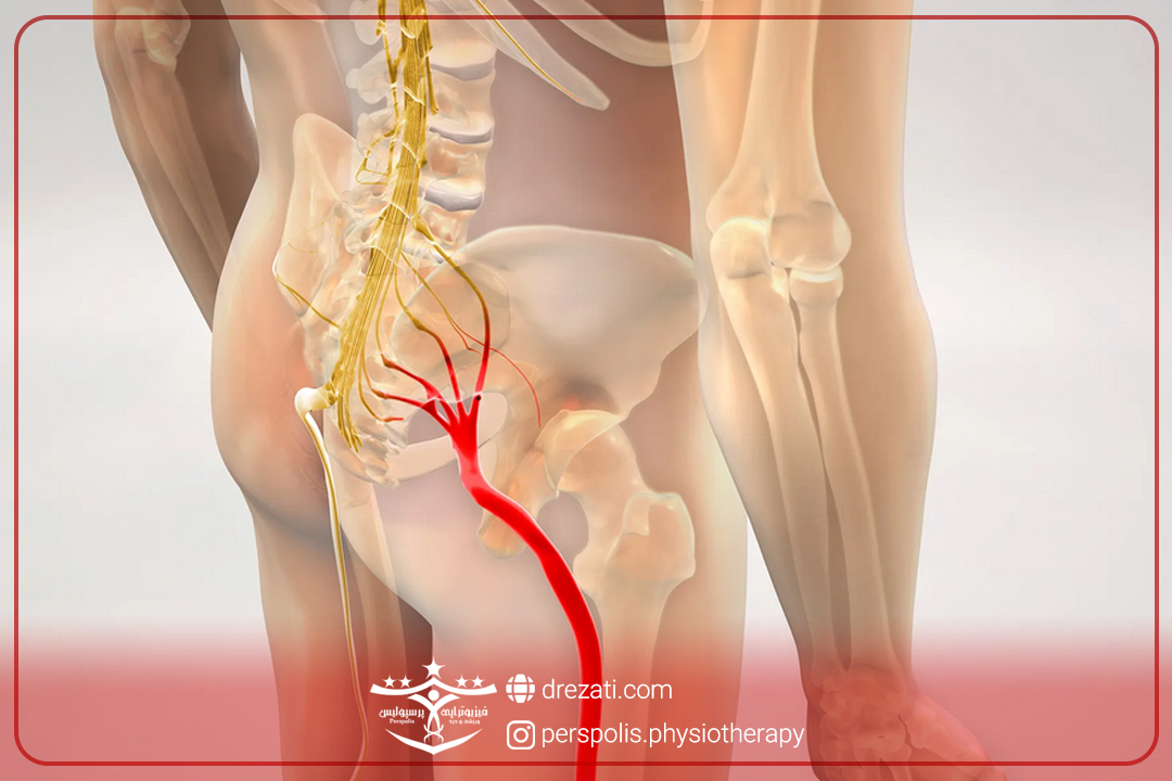 تنگی کانال نخاعی کمر