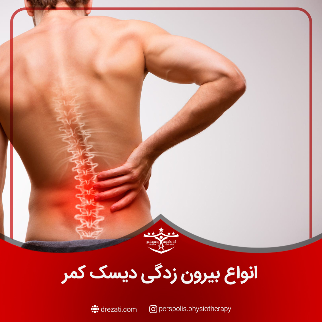 انواع بیرون زدگی دیسک کمر