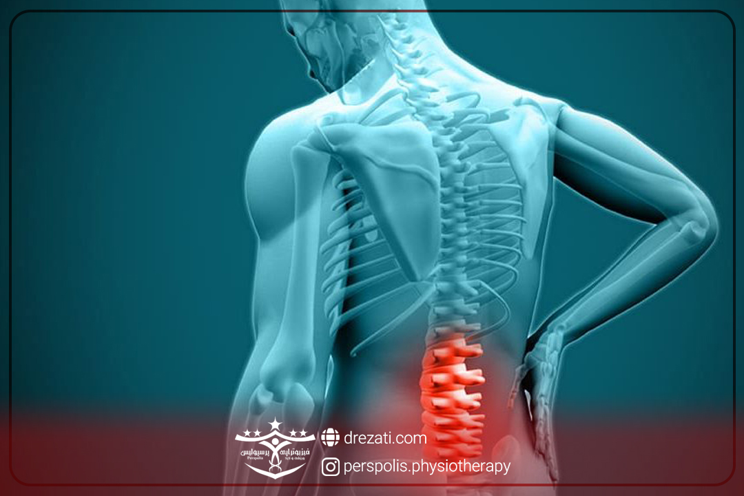 انواع بیرون زدگی دیسک کمر