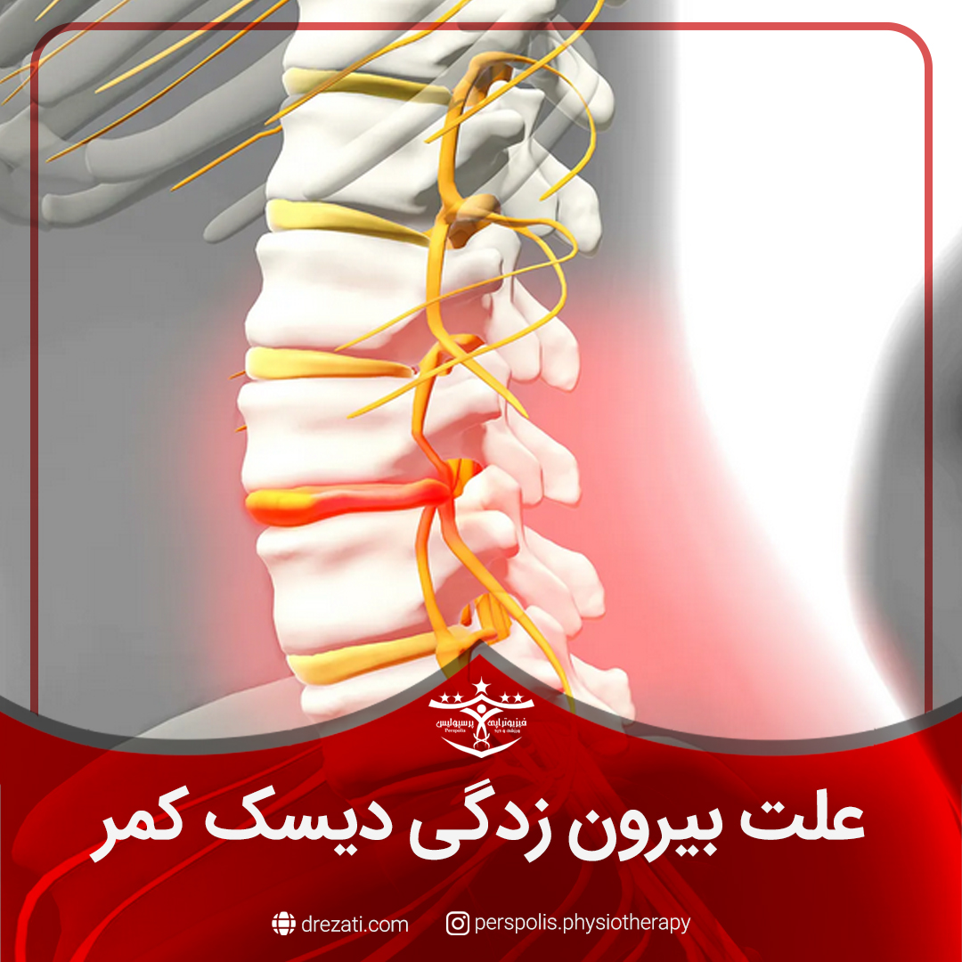 علت بیرون زدگی دیسک کمر