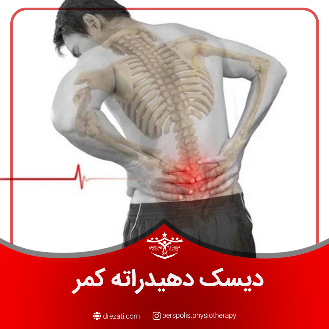 دیسک دهیدراته کمر