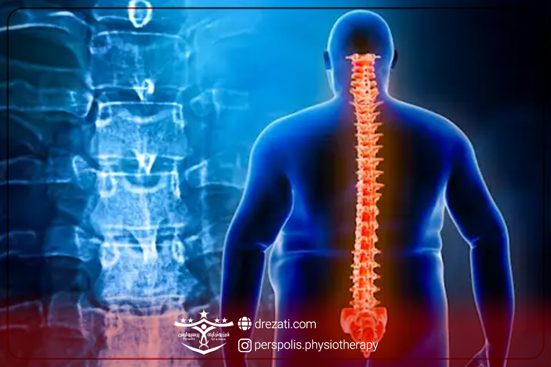 دیسک دهیدراته کمر