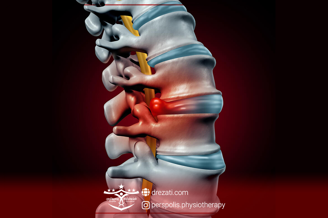 دیسک دهیدراته کمر