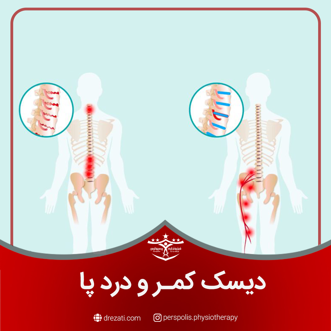 دیسک کمر و درد پا