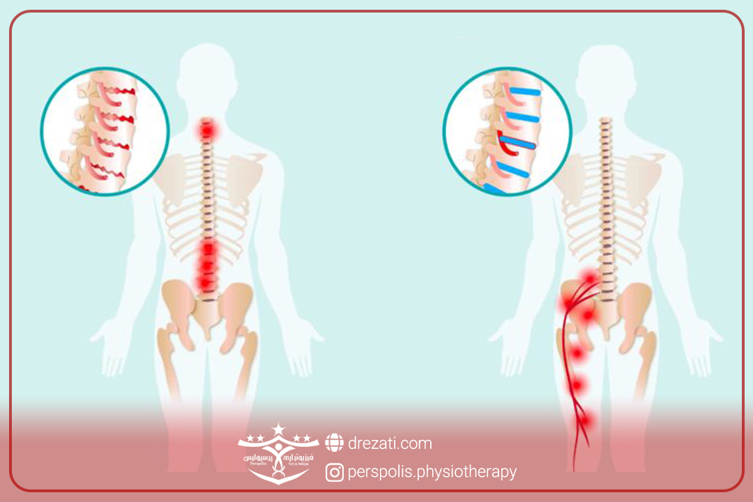 دیسک کمر و درد پا