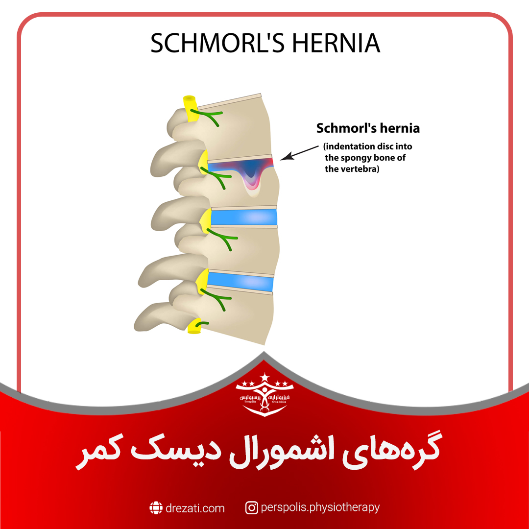 گره‌های اشمورال دیسک کمر