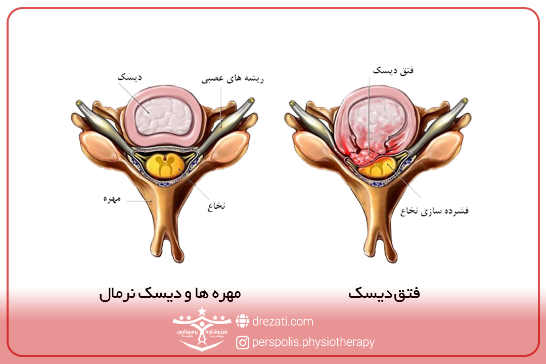 انواع بیرون زدگی دیسک گردن