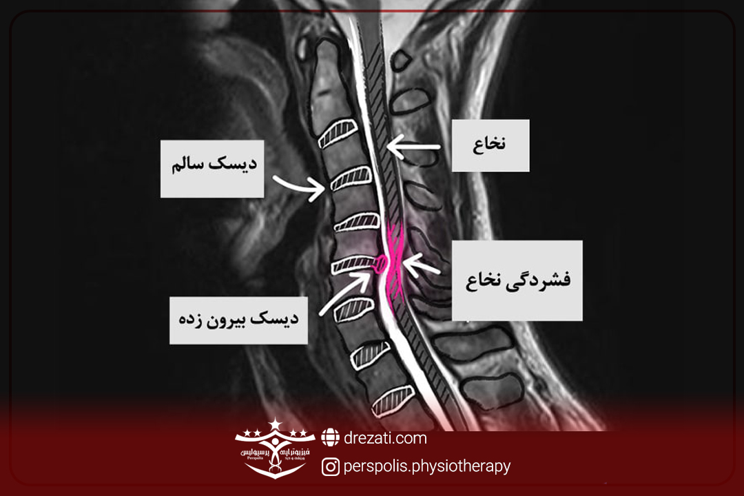 انواع بیرون زدگی دیسک گردن