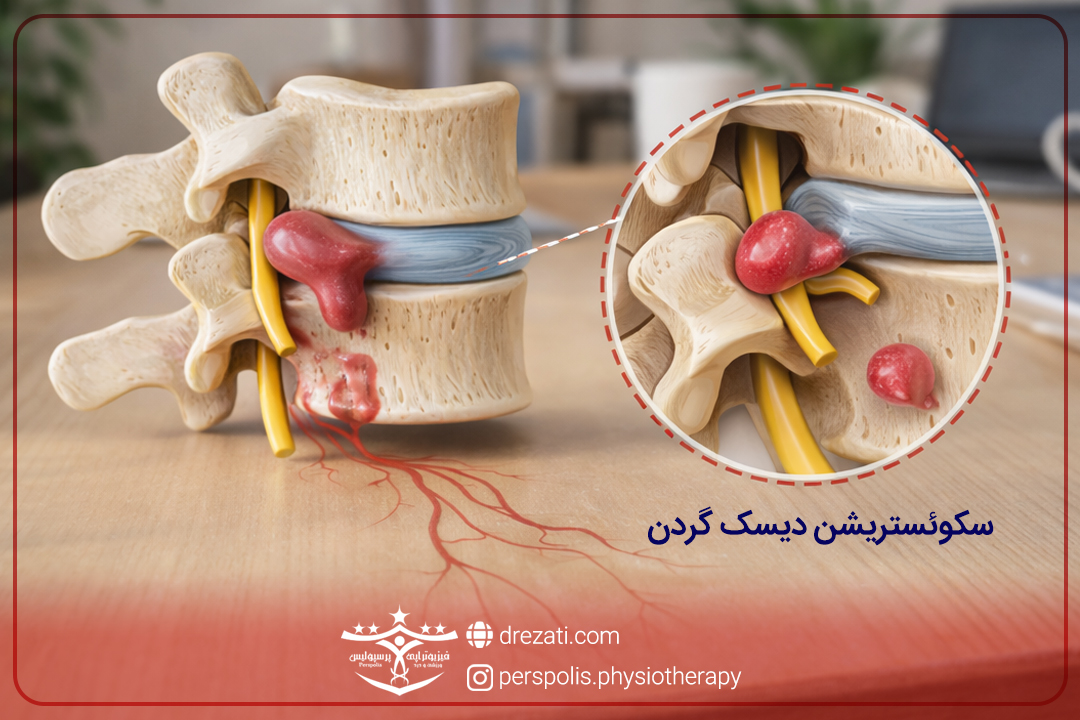 نشانه های بیمار در انواع بیرون زدگی دیسک گردن