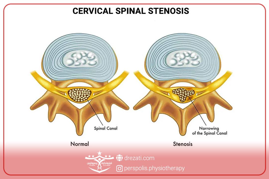 تنگی کانال نخاعی گردن