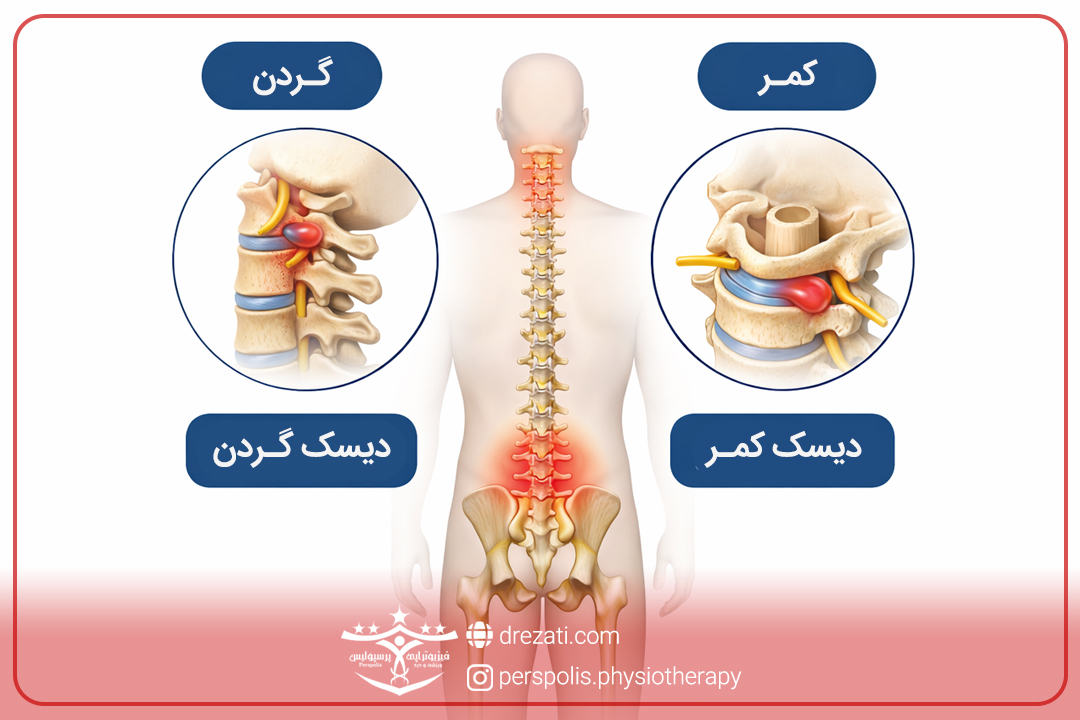 فرق دیسک گردن و کمر