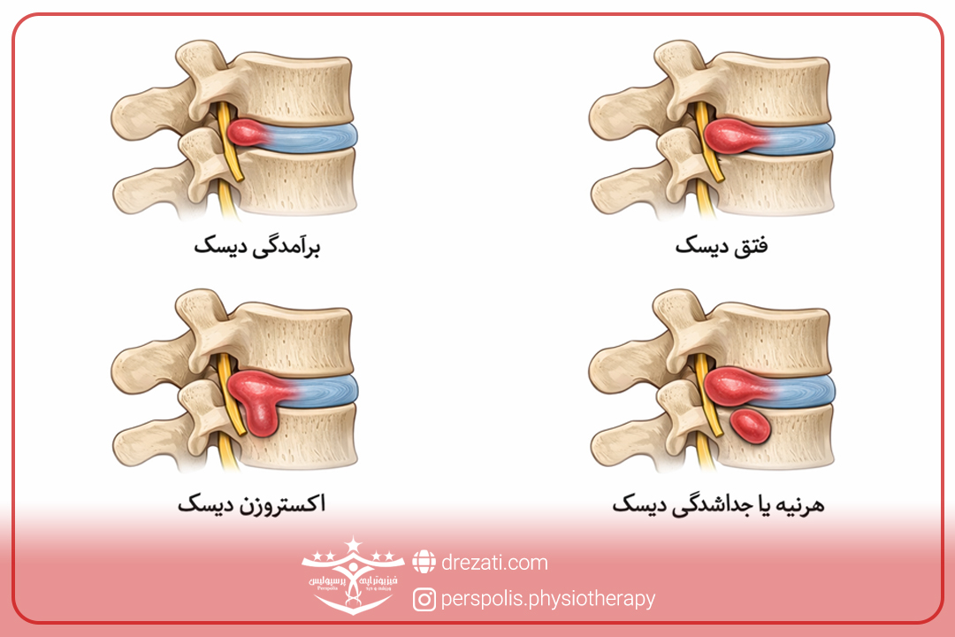 نشانه های بیمار در انواع بیرون زدگی دیسک گردن