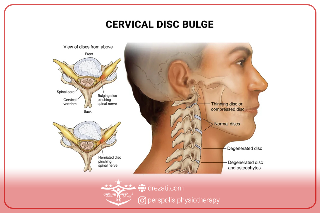محتویات دیسک گردن