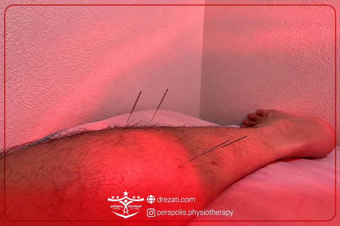 طب سوزنی در رشت
