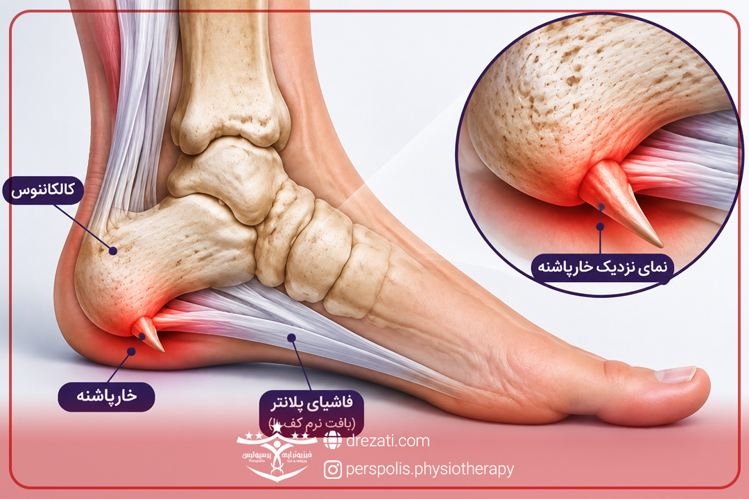 شاک ویو خارپاشنه در رشت